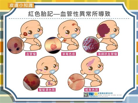 膝蓋有胎記|認識胎記的種類與治療照顧